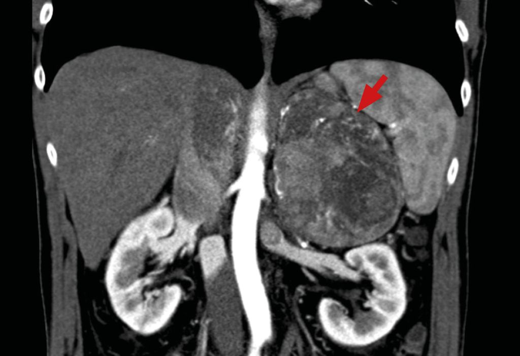 Wie Erkennt Man Einen Tumor www.universimed.com